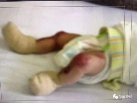 중국  피부결실 아기 출처 - 'Aihami'
